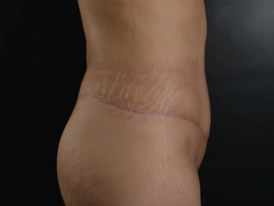 Perfil del abdomen después de la cirugía de contorno corporal
