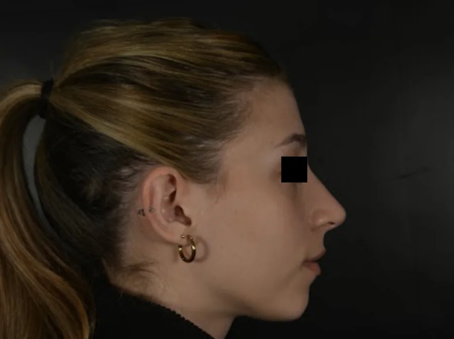 Perfil de nariz después de la rinoplastia
